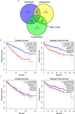 High SAA1 Expression Predicts Advanced Tumors in Renal Cancer